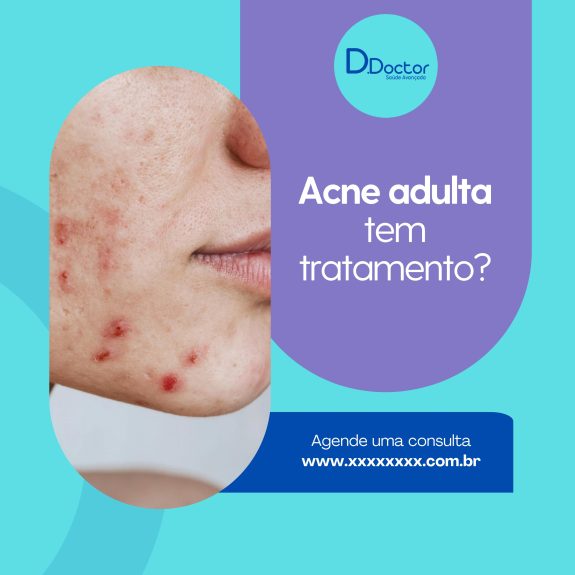 acne adulta