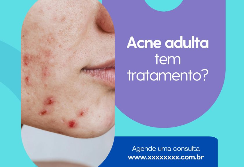 acne adulta