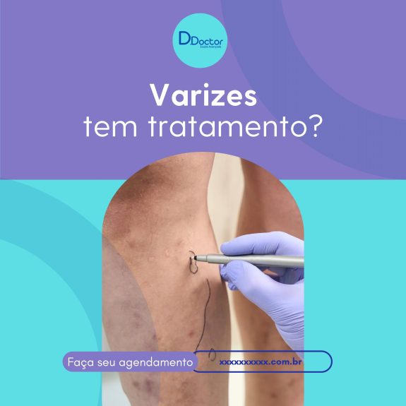 varizes