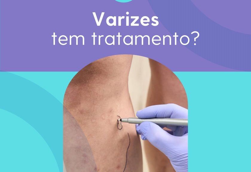 varizes